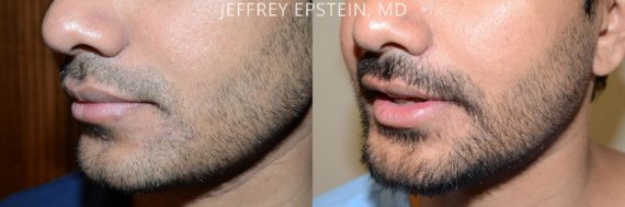 Facial Hair Transplant Before and after in Miami, FL, Paciente 53758
