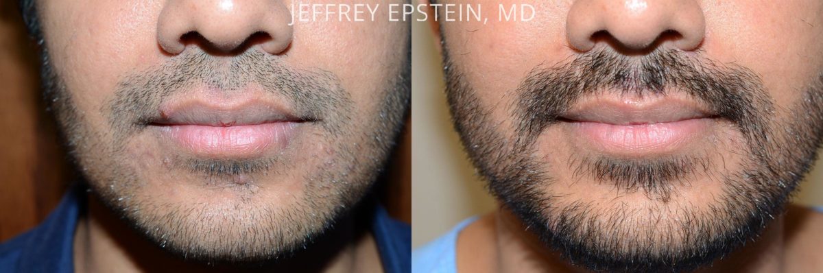Trasplante de Pelo Facial Antes y después en Miami, FL, Paciente 71216