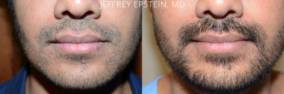 Facial Hair Before and after in Miami, FL, Paciente 53758