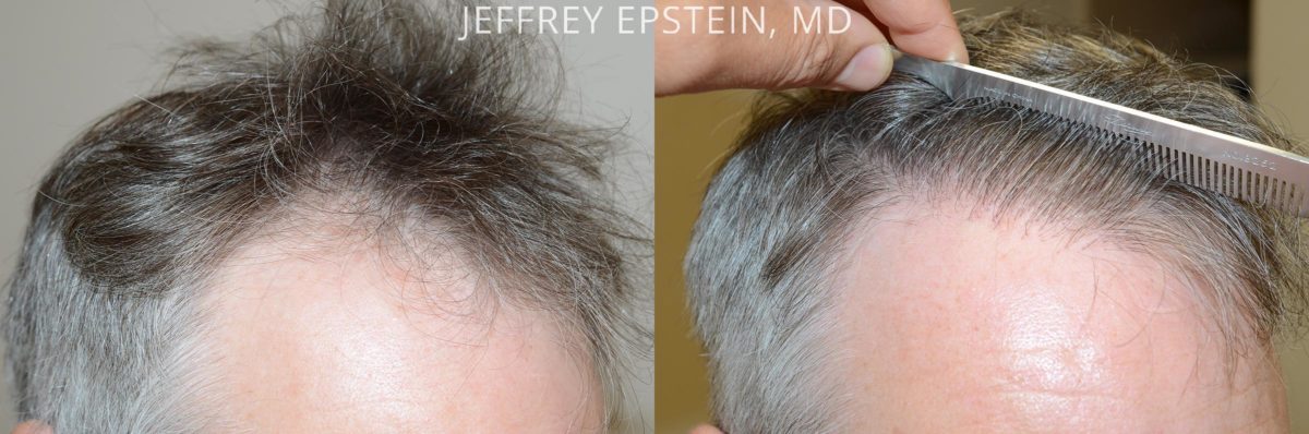 Hair Transplants for Men Before and after in Miami, FL, Paciente 53790