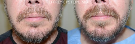 Facial Hair Before and after in Miami, FL, Paciente 53810