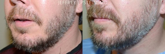 Facial Hair Transplant Before and after in Miami, FL, Paciente 53810