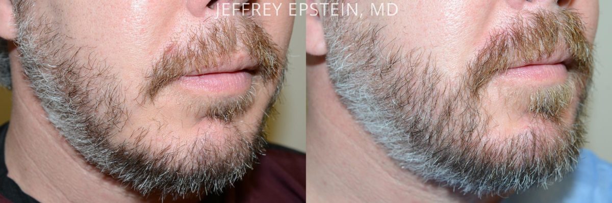 Trasplante de Pelo Facial Antes y después en Miami, FL, Paciente 71191