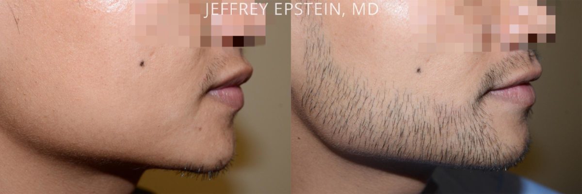 Facial Hair Transplant Before and after in Miami, FL, Paciente 53910