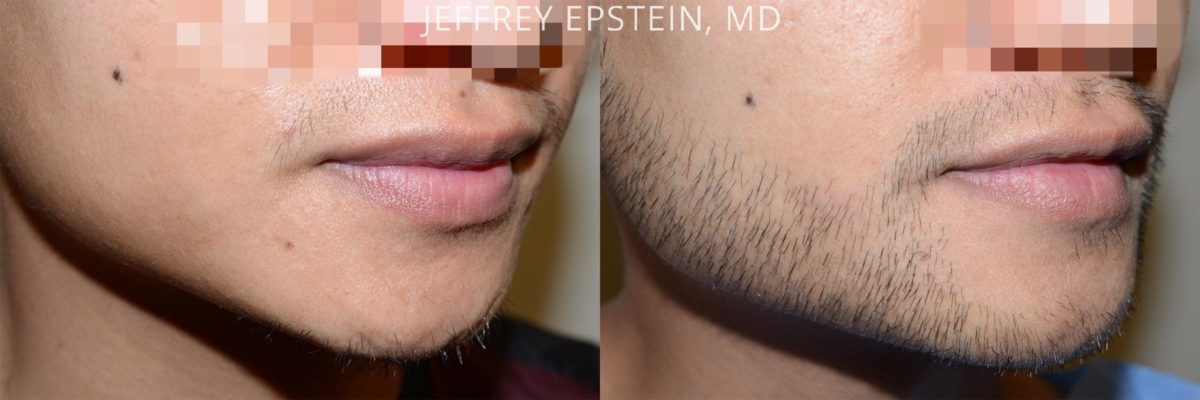 Facial Hair Transplant Before and after in Miami, FL, Paciente 53910