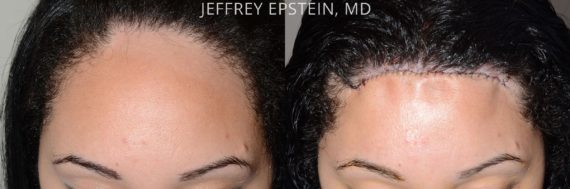 Hairline Advancement Before and after in Miami, FL, Paciente 53831