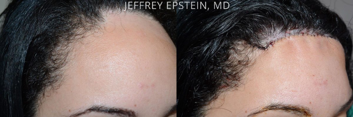 Hairline Advancement Before and after in Miami, FL, Paciente 53831