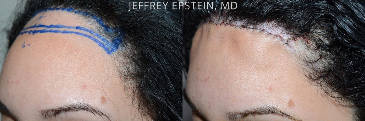Forehead Reduction Surgery Before and after in Miami, FL, Paciente 53831