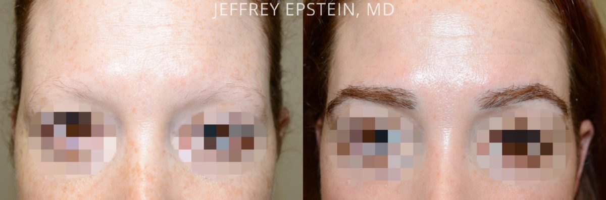 Eyebrow Hair Transplant Before and after in Miami, FL, Paciente 53867