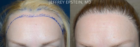Hairline Advancement Before and after in Miami, FL, Paciente 53986