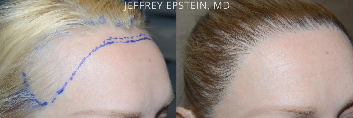 Forehead Reduction Surgery Before and after in Miami, FL, Paciente 53986