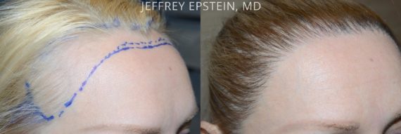 Hairline Advancement Before and after in Miami, FL, Paciente 53986