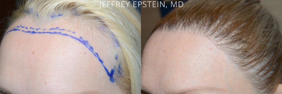 Forehead Reduction Surgery Before and after in Miami, FL, Paciente 53986