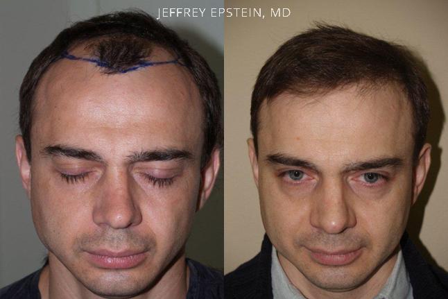Hair Transplants for Men Before and after in Miami, FL, Paciente 46882