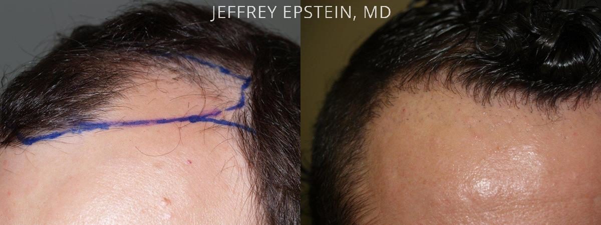 Hair Transplants for Men Before and after in Miami, FL, Paciente 46882
