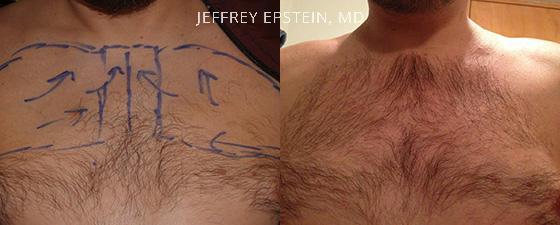 Body Hair Transplant Before and after in Miami, FL, Paciente 35057