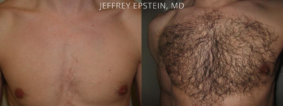 Body Hair Transplant Before and after in Miami, FL, Paciente 35066
