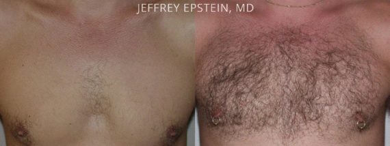 Body Hair Before and after in Miami, FL, Paciente 35070