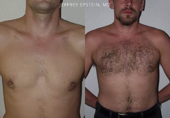 Body Hair Transplant Before and after in Miami, FL, Paciente 35070