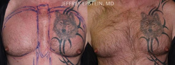 Body Hair Transplant Before and after in Miami, FL, Paciente 35075