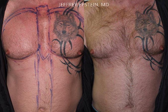 Body Hair Before and after in Miami, FL, Paciente 35075
