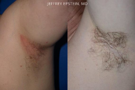 Body Hair Before and after in Miami, FL, Paciente 35080