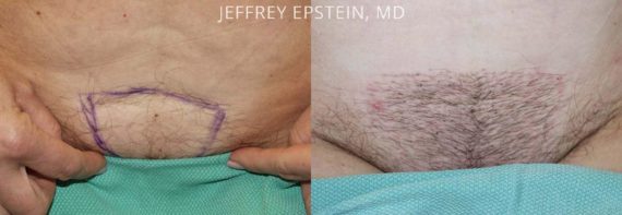 Body Hair Transplant Before and after in Miami, FL, Paciente 35085