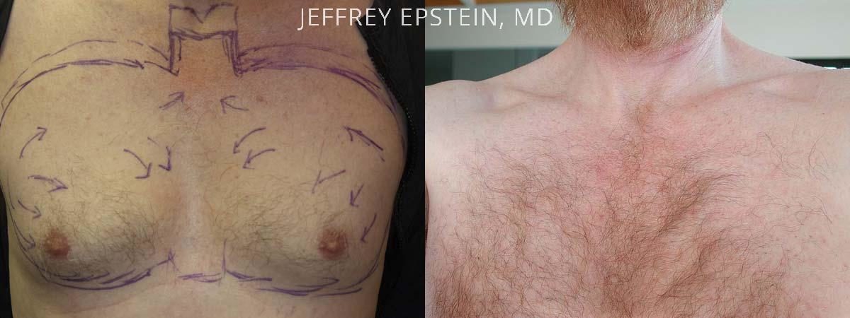 Body Hair Transplant Before and after in Miami, FL, Paciente 35088