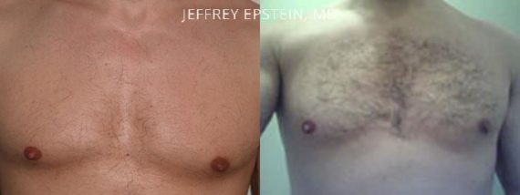 Body Hair Transplant Before and after in Miami, FL, Paciente 35091