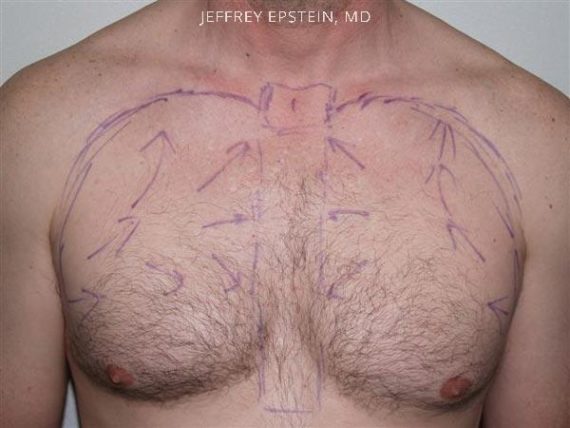 Body Hair Transplant Before and after in Miami, FL, Paciente 35101