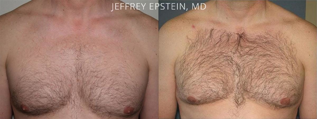 Body Hair Transplant Before and after in Miami, FL, Paciente 35101