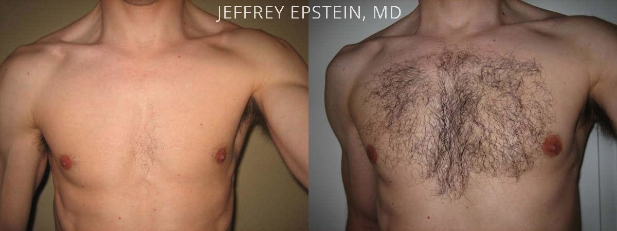 Body Hair Transplant Before and after in Miami, FL, Paciente 35105