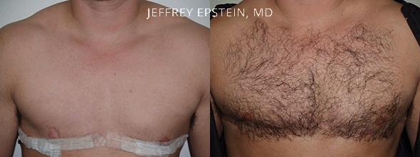 Body Hair Transplant Before and after in Miami, FL, Paciente 35108