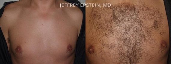 Body Hair Transplant Before and after in Miami, FL, Paciente 35114