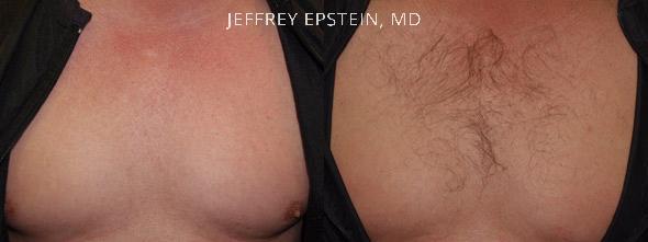 Body Hair Transplant Before and after in Miami, FL, Paciente 35122