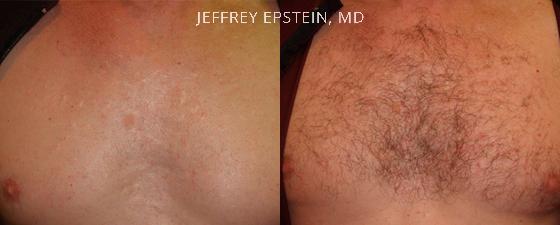 Body Hair Transplant Before and after in Miami, FL, Paciente 35125