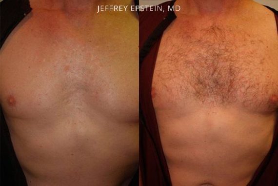 Body Hair Before and after in Miami, FL, Paciente 35125