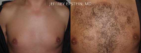 Body Hair Transplant Before and after in Miami, FL, Paciente 35130