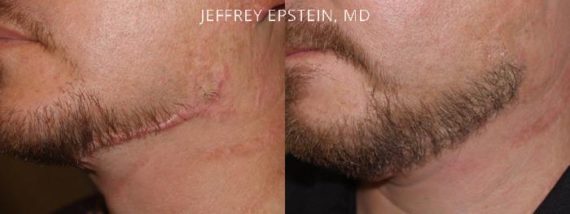 Facial Hair Transplant Before and after in Miami, FL, Paciente 35140