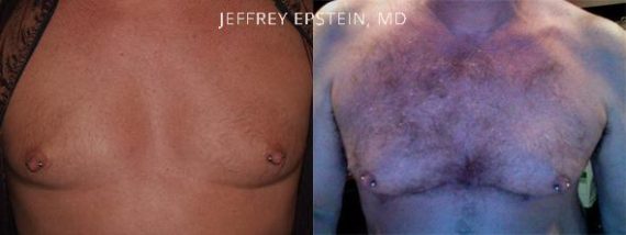 Body Hair Before and after in Miami, FL, Paciente 35143
