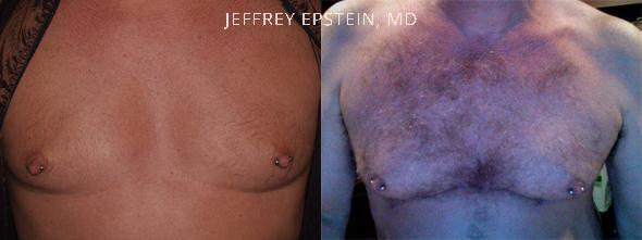 Body Hair Transplant Before and after in Miami, FL, Paciente 35143