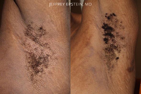 Body Hair Transplant Before and after in Miami, FL, Paciente 35146