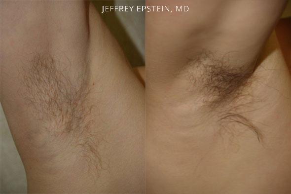 Body Hair Transplant Before and after in Miami, FL, Paciente 35151