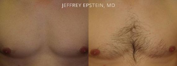 Body Hair Before and after in Miami, FL, Paciente 35151