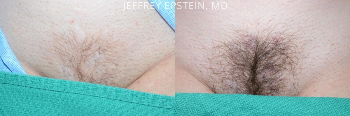 Body Hair Transplant Before and after in Miami, FL, Paciente 35158