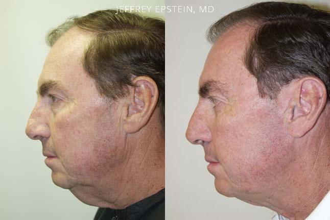 Combo Procedures Before and after in Miami, FL, Paciente 35179