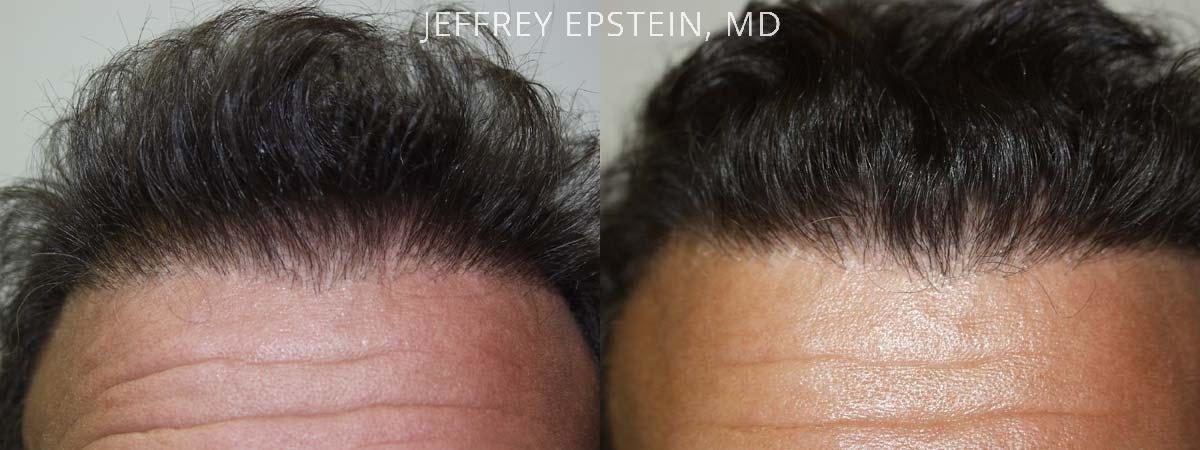 Combo Procedures Before and after in Miami, FL, Paciente 35184