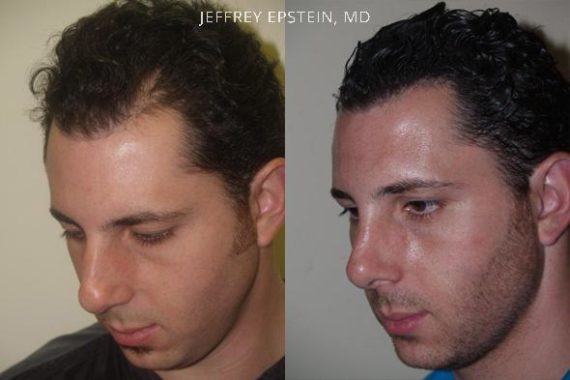 Combo Procedures Before and after in Miami, FL, Paciente 35195
