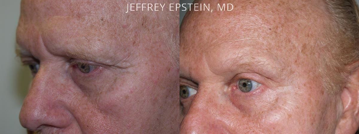 Combo Procedures Before and after in Miami, FL, Paciente 35200