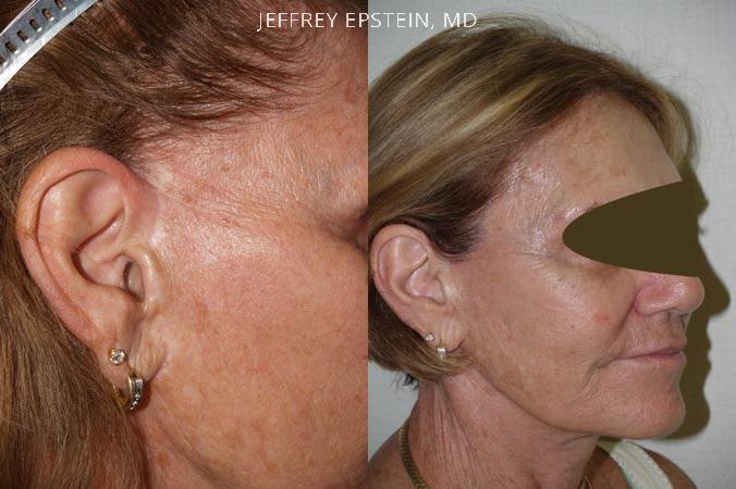 Combo Procedures Before and after in Miami, FL, Paciente 35207